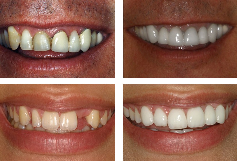 Dental Implant Before and After Photos