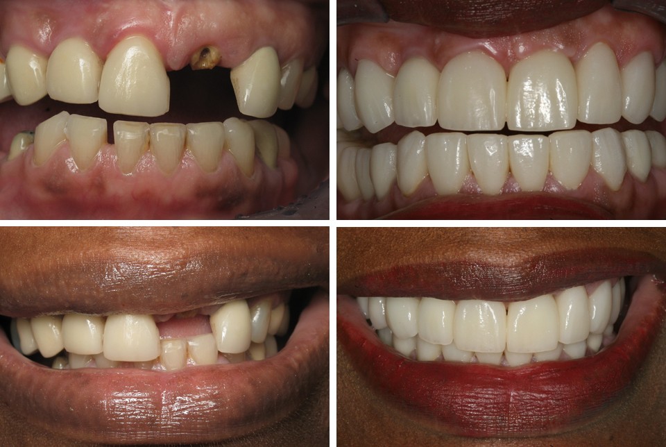 Dental Implant Before and After Photos