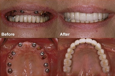 Mini Dental Implants Vs Common Dental Implants