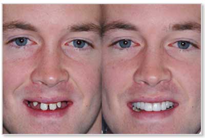 Dental Implants | Regency House Dental