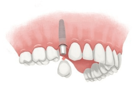 Dental Implant Cost | Consumer Information & Prices Paid