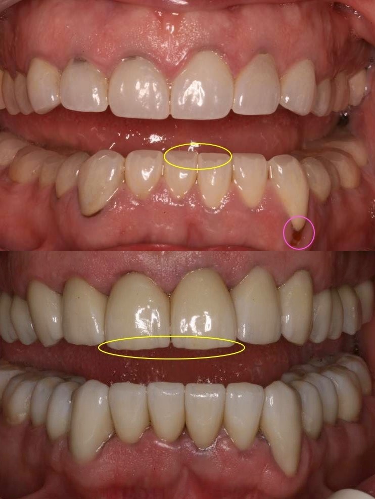 21 Dental Implant Before and After Photos