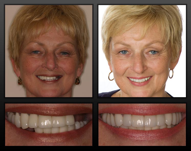 before-and-after-dental-implant