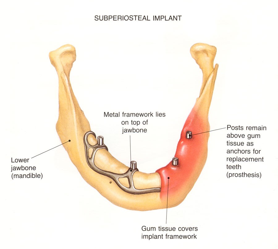 Types of Dental Implants by Sizes, Procedures and Materials