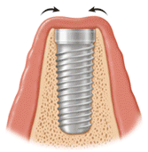 Implant Covered by Gum Tissue