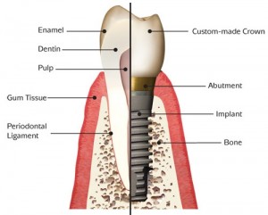 Parts of a tooth implant