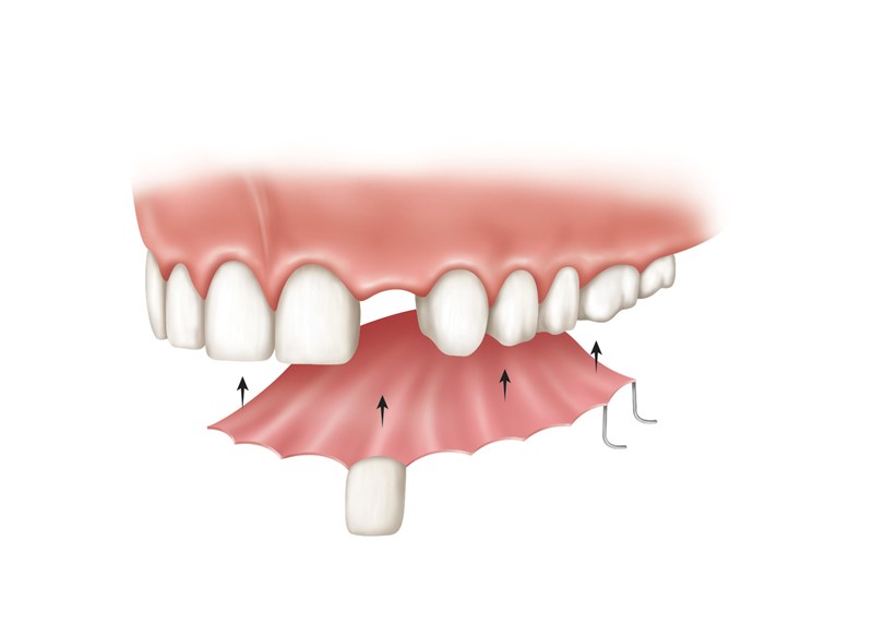 Dentures vs Dental Implants Comparison of Costs & Benefits