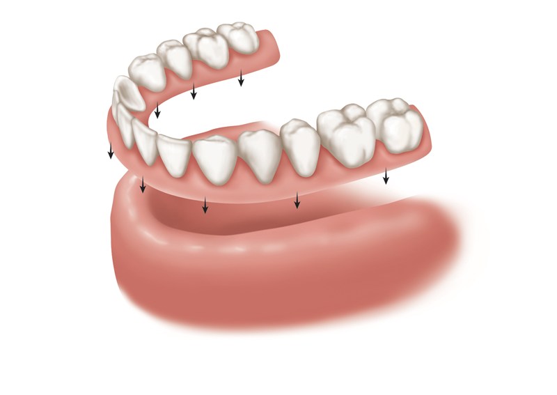Dentures vs Dental Implants Comparison of Costs & Benefits