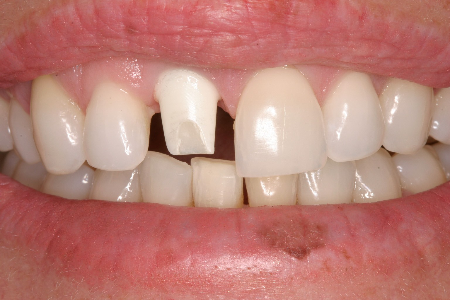 Complete Dental Implant Surgery Guide What to Expect