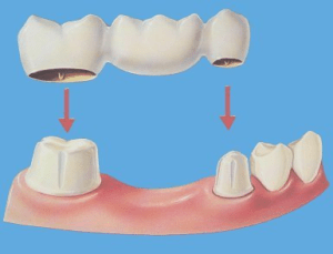Dental Bridges Cost, Types & Procedure